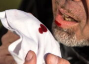 Penderita TB Capai 1.500 Orang, Dinkes Padang Bentuk Tim Penanggulangan Tuberkulosis