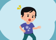 Penyakit Campak Meningkat, IDAI Sumbar Ajak Orang Tua Segera Bawa Anak Imunisasi