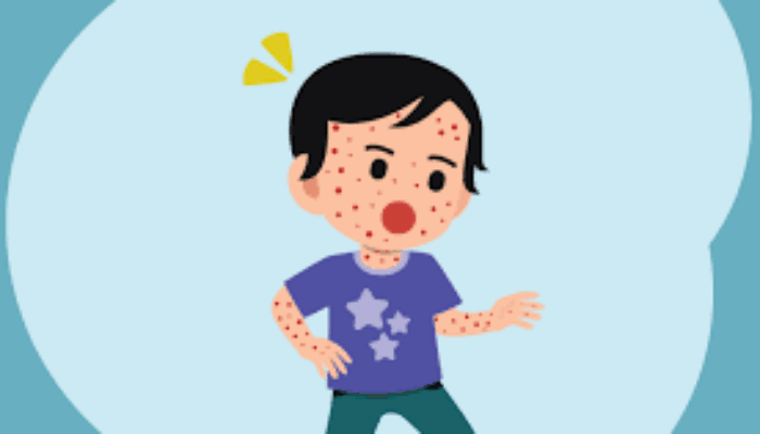 Penyakit Campak Meningkat, IDAI Sumbar Ajak Orang Tua Segera Bawa Anak Imunisasi