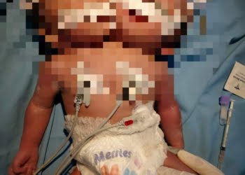Mohon Doa! Bayi Kembar Siam di Limau Puruik Padang Pariaman Dirujuk ke RSUP M. Djamil Padang