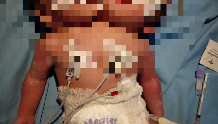 Sempat Kritis, Bayi Kembar Siam Dua Kepala Satu Badan Meninggal Dunia