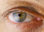 Memahami Pengertian Gangguan Penglihatan Katarak dan Pengobatannya