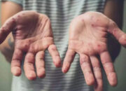 Antisipasi Monkeypox, Pemerintah Diminta Perketat Pengawasan Jalur Masuk dari Luar Negeri