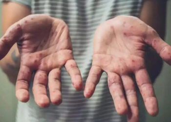 DPR RI meminta pemerintah meningkatkan upaya pencegahan penyebaran virus Monkeypox (Mpox) atau penyakit cacar monyet