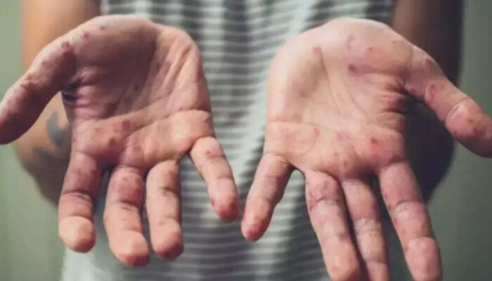 Antisipasi Cacar Monyet, Dinkes Padang Ingatkan Masyarakat Pola Hidup Sehat