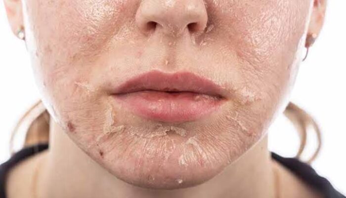 Dapatkan Kulit Sehat dengan Eksfoliasi dan Peeling Alami, Begini Caranya!