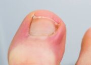 Cara Mengobati Kuku Kaki Cantengan dengan Tepat