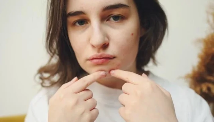 Tips Agar Wajah Bebas dari Jerawat